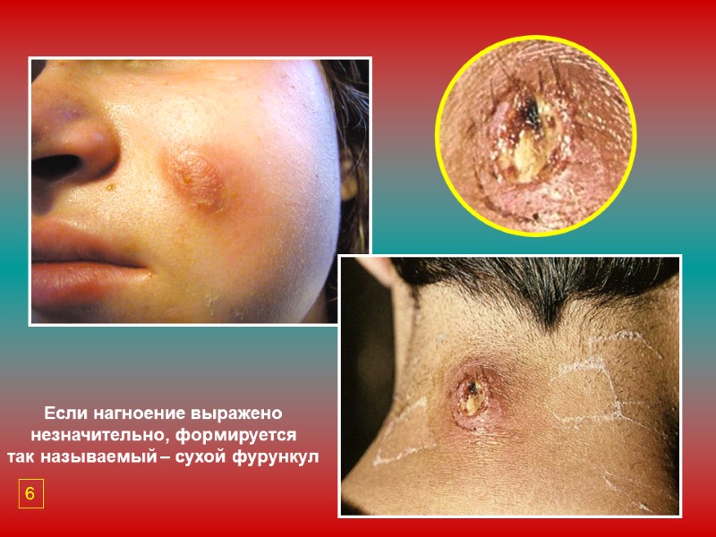 Если нагноение выражено незначительно, формируется так называемый – сухой фурункул 6